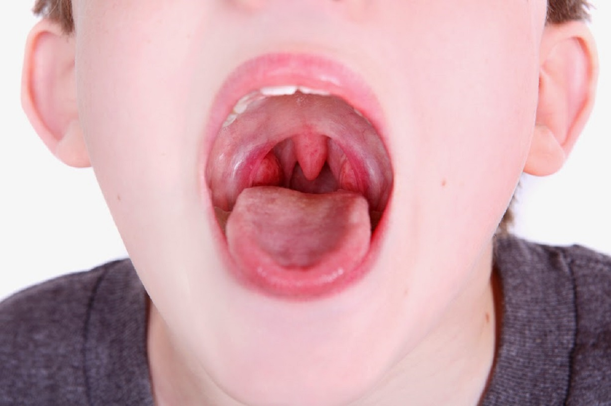 Viêm Họng: Nguyên Nhân, Triệu Chứng Và Cách Điều Trị