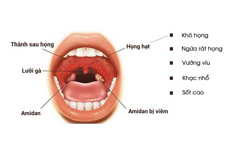 Các triệu chứng của viêm họng