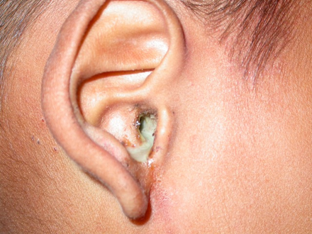 VIÊM TAI GIỮA: NGUYÊN NHÂN, TRIỆU CHỨNG, ĐIỀU TRỊ